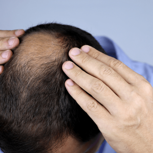 Benefits of Using a Proven DHT Blocker - Mirasoa Cares