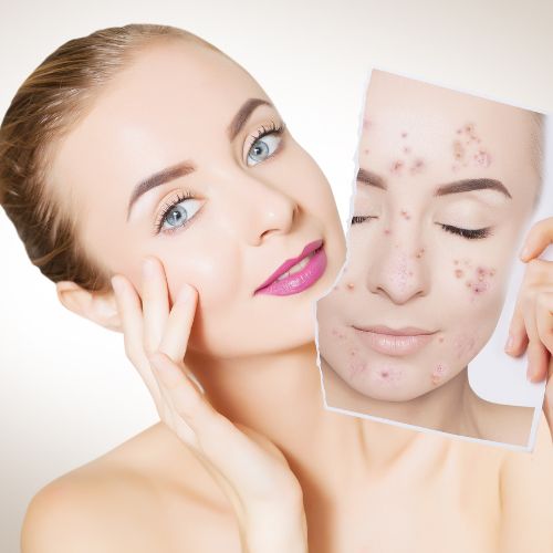 Rebound Effect on Skin - Mirasoa Cares